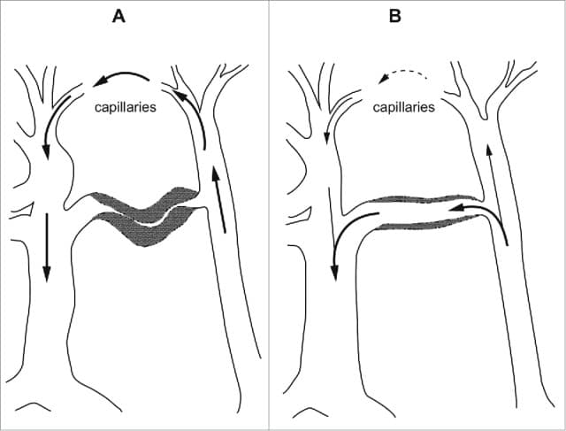 Diagram showing how an arteriovenous anastomosis (AVA) shunts blood directly from artery to vein, bypassing capillaries